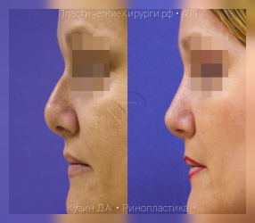 ринопластика, результат №400, предварительное изображение до и после операции