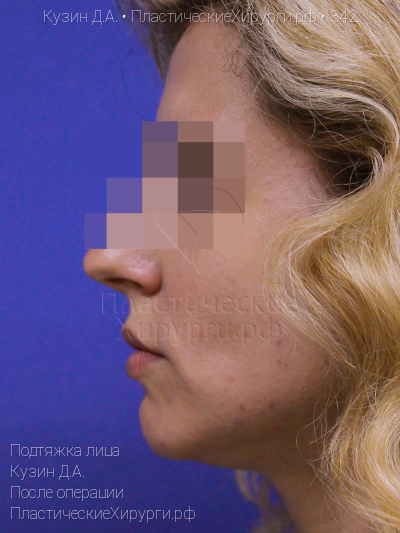 подтяжка лица, пластический хирург Кузин Д. А., результат №342, ракурс 3, фото после операции