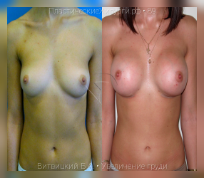 увеличение груди, результат №89, предварительное изображение до и после операции
