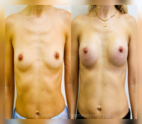 увеличение груди, результат №427, предварительное изображение до и после операции