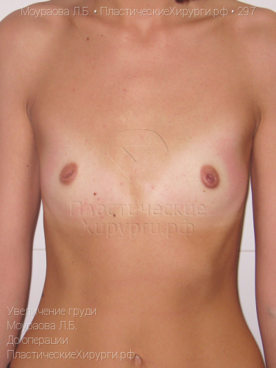увеличение груди, пластический хирург Моураова Л. Б., результат №297, ракурс 1, фото до операции