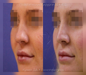 ринопластика, результат №402, предварительное изображение до и после операции