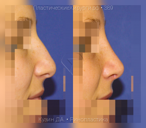 ринопластика, результат №389, предварительное изображение до и после операции