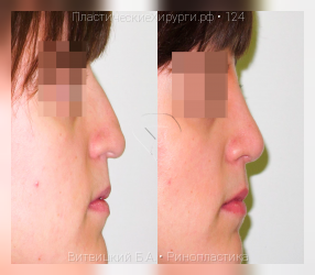 ринопластика, результат №124, предварительное изображение до и после операции