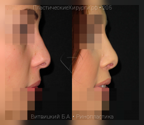 ринопластика, результат №205, предварительное изображение до и после операции
