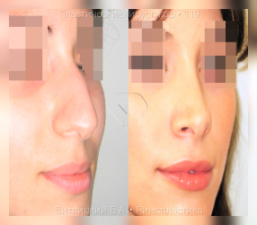 ринопластика, результат №119, предварительное изображение до и после операции