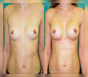 увеличение груди, результат №81, предварительное изображение до и после операции