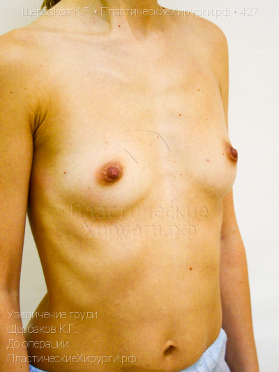 увеличение груди, пластический хирург Щербаков К. Г., результат №427, ракурс 2, фото до операции