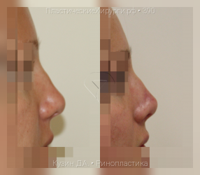 ринопластика, результат №390, предварительное изображение до и после операции
