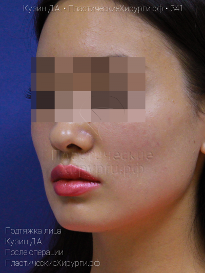 подтяжка лица, пластический хирург Кузин Д. А., результат №341, ракурс 2, фото после операции
