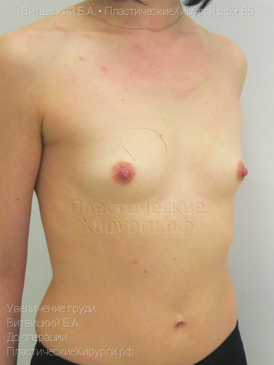 увеличение груди, пластический хирург Витвицкий Б. А., результат №66, ракурс 2, фото до операции