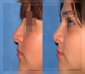 ринопластика, результат №213, предварительное изображение до и после операции