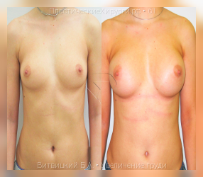 увеличение груди, результат №61, предварительное изображение до и после операции