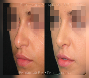 ринопластика, результат №247, предварительное изображение до и после операции