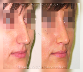 ринопластика, результат №178, предварительное изображение до и после операции