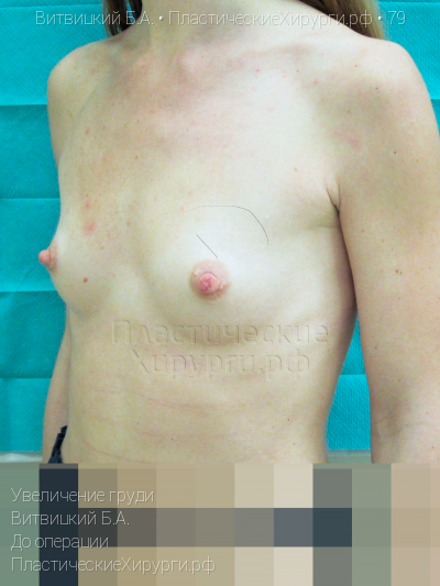 увеличение груди, пластический хирург Витвицкий Б. А., результат №79, ракурс 2, фото до операции