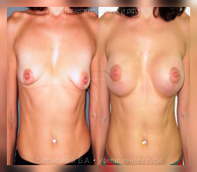увеличение груди, результат №84, предварительное изображение до и после операции