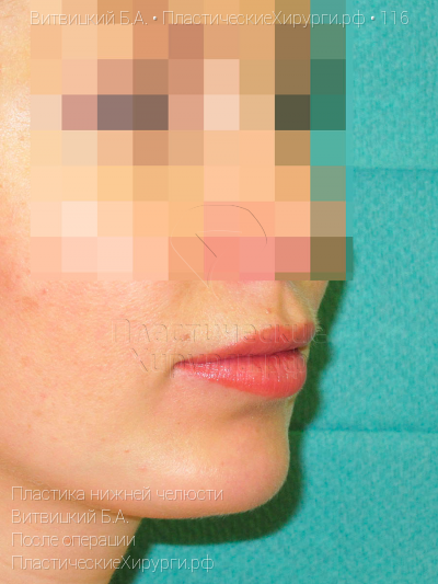 пластика нижней челюсти, пластический хирург Витвицкий Б. А., результат №116, ракурс 1, фото после операции