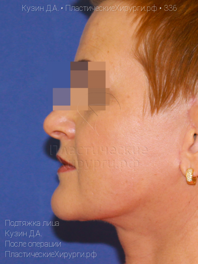 подтяжка лица, пластический хирург Кузин Д. А., результат №336, ракурс 3, фото после операции