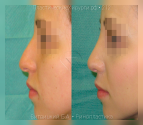 ринопластика, результат №212, предварительное изображение до и после операции