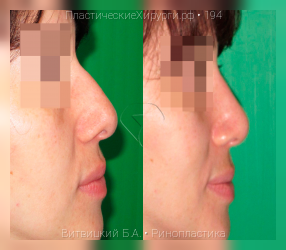 ринопластика, результат №194, предварительное изображение до и после операции