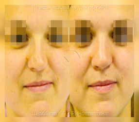 ринопластика, результат №481, предварительное изображение до и после операции