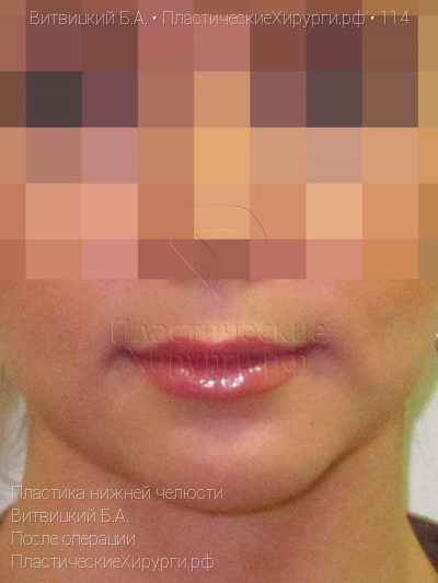 пластика нижней челюсти, пластический хирург Витвицкий Б. А., результат №114, ракурс 1, фото после операции