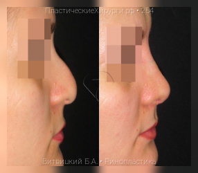 ринопластика, результат №254, предварительное изображение до и после операции