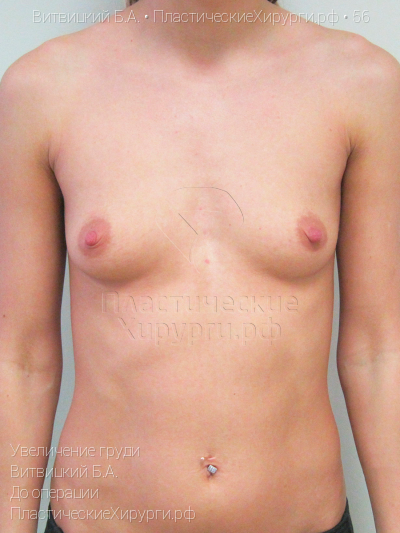 увеличение груди, пластический хирург Витвицкий Б. А., результат №56, ракурс 1, фото до операции
