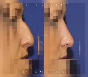 ринопластика, результат №391, предварительное изображение до и после операции