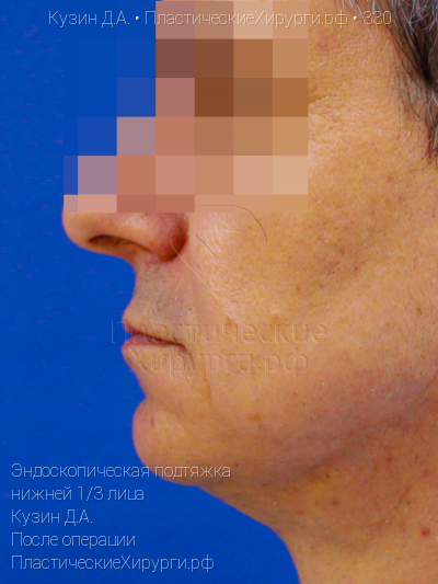 эндоскопическая подтяжка нижней трети лица, пластический хирург Кузин Д. А., результат №330, ракурс 3, фото после операции