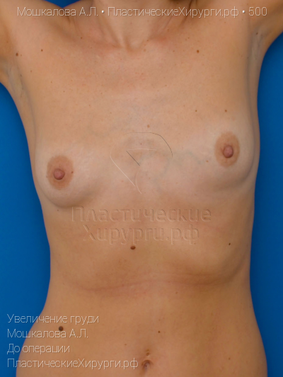 увеличение груди, пластический хирург Мошкалова А. Л., результат №500, ракурс 6, фото до операции