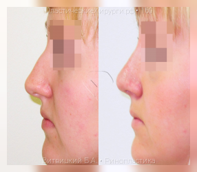 ринопластика, результат №169, предварительное изображение до и после операции