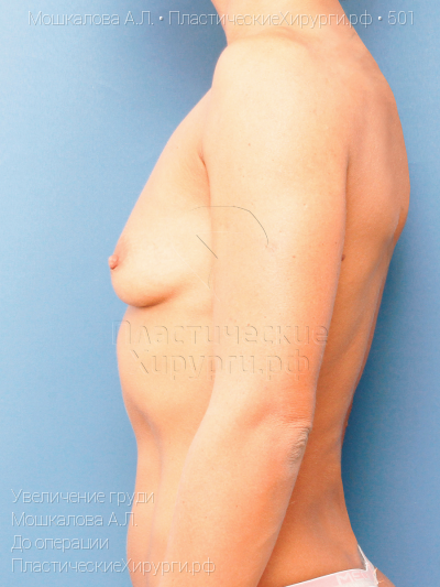 увеличение груди, пластический хирург Мошкалова А. Л., результат №501, ракурс 5, фото до операции
