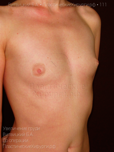 увеличение груди, пластический хирург Витвицкий Б. А., результат №111, ракурс 2, фото до операции