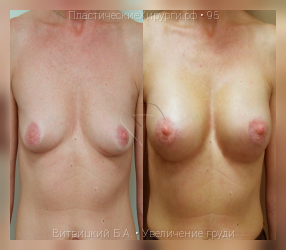 увеличение груди, результат №95, предварительное изображение до и после операции
