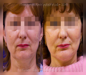 подтяжка лица, результат №334, предварительное изображение до и после операции