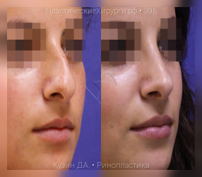 ринопластика, результат №395, предварительное изображение до и после операции