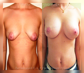 увеличение груди, результат №101, предварительное изображение до и после операции