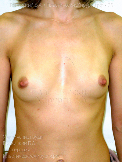 увеличение груди, пластический хирург Витвицкий Б. А., результат №36, ракурс 1, фото до операции