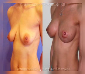 увеличение груди, результат №92, предварительное изображение до и после операции