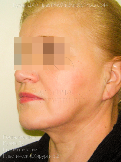 подтяжка лица, пластический хирург Кузин Д. А., результат №344, ракурс 2, фото после операции