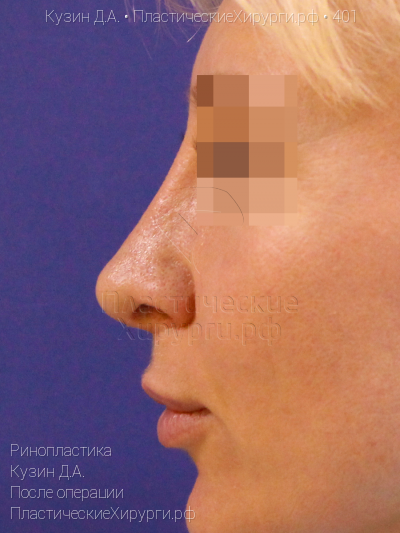 ринопластика, пластический хирург Кузин Д. А., результат №401, ракурс 3, фото после операции