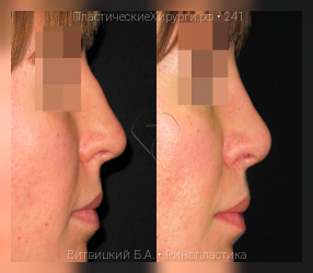 ринопластика, результат №241, предварительное изображение до и после операции