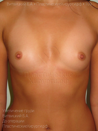 увеличение груди, пластический хирург Витвицкий Б. А., результат №109, ракурс 1, фото до операции