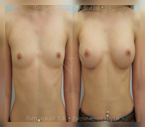 увеличение груди, результат №64, предварительное изображение до и после операции