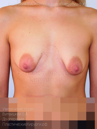 увеличение груди, пластический хирург Витвицкий Б. А., результат №83, ракурс 1, фото до операции