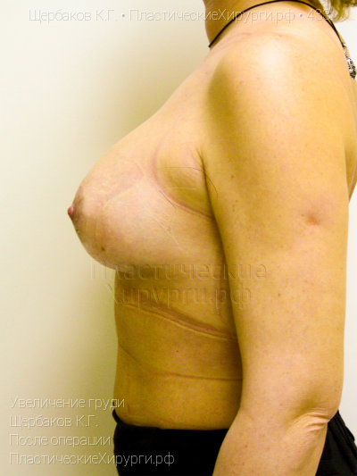 увеличение груди, пластический хирург Щербаков К. Г., результат №433, ракурс 5, фото после операции