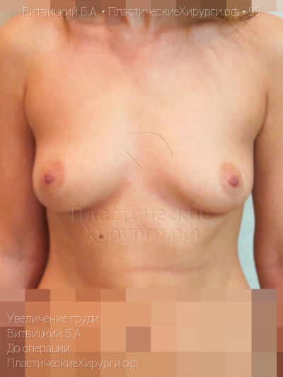увеличение груди, пластический хирург Витвицкий Б. А., результат №99, ракурс 1, фото до операции