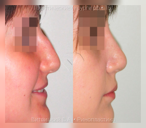 ринопластика, результат №151, предварительное изображение до и после операции
